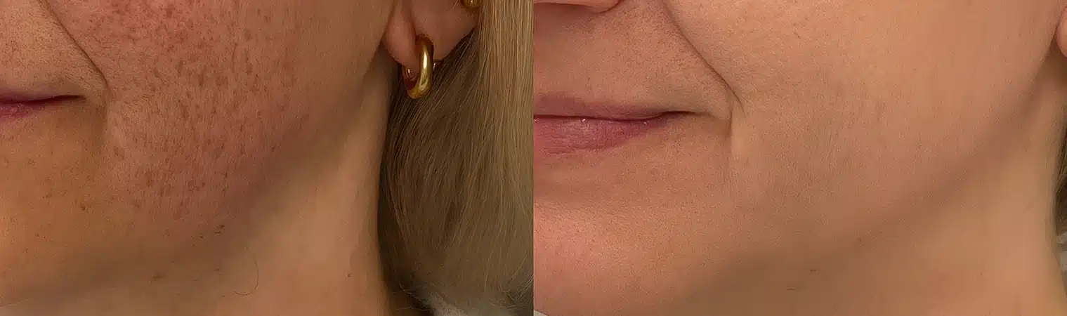 How BioRePeel Differs from Traditional Chemical Peels