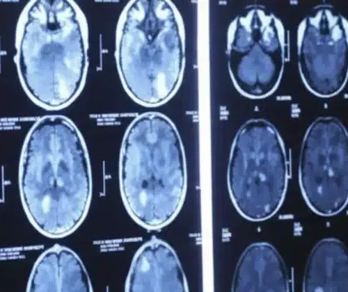 HRT for Breast Cancer Survivors: New Expert Consensus and the MENO-ABC Trial Challenge Decades of Contraindications